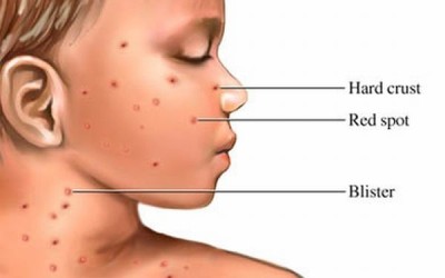 Is the chickenpox vaccine a good choice for your child?